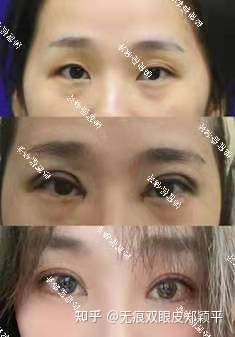 开扇双眼皮6毫米宽吗,双眼皮7.5毫米宽吗