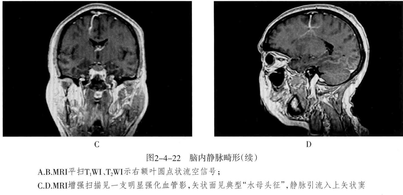 颅内血管周围间隙的影像鉴别,颅脑血管源性疾病影像诊断
