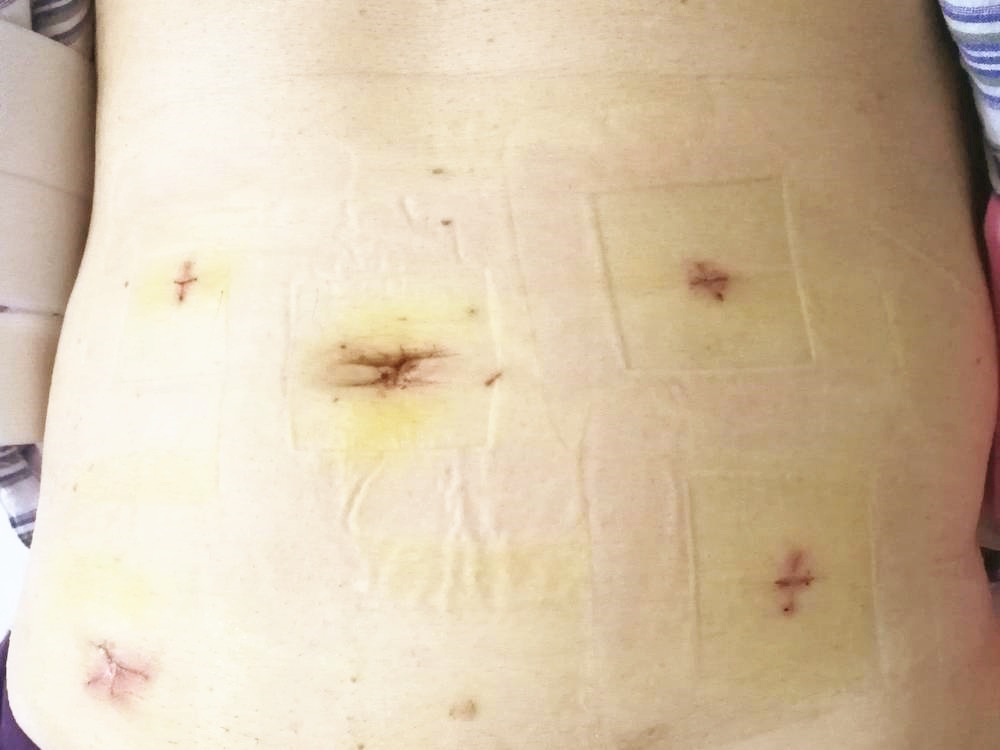 肿瘤切除取出,微创手术切除的肿瘤怎么取出体外