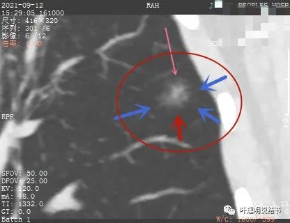 怎样从病理报告看是不是原位癌,原位腺癌切除子宫要开刀吗