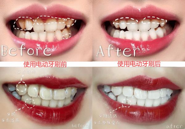为什么牙科推荐电动牙刷,电动牙刷对口腔有好处吗