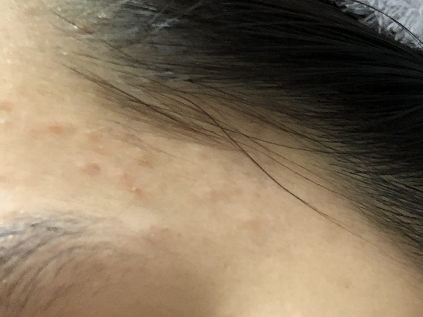 17岁的孩子身上脸上长了好多痘痘,17岁女孩脸上长好多痘痘怎么办