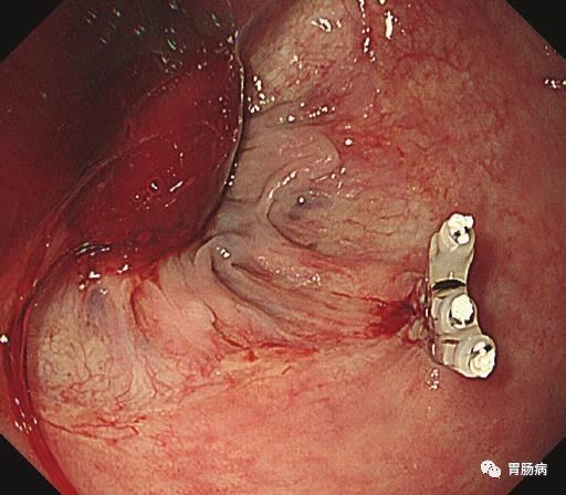 内镜下消化道出血的治疗简报,消化道出血内镜下止血治疗处方