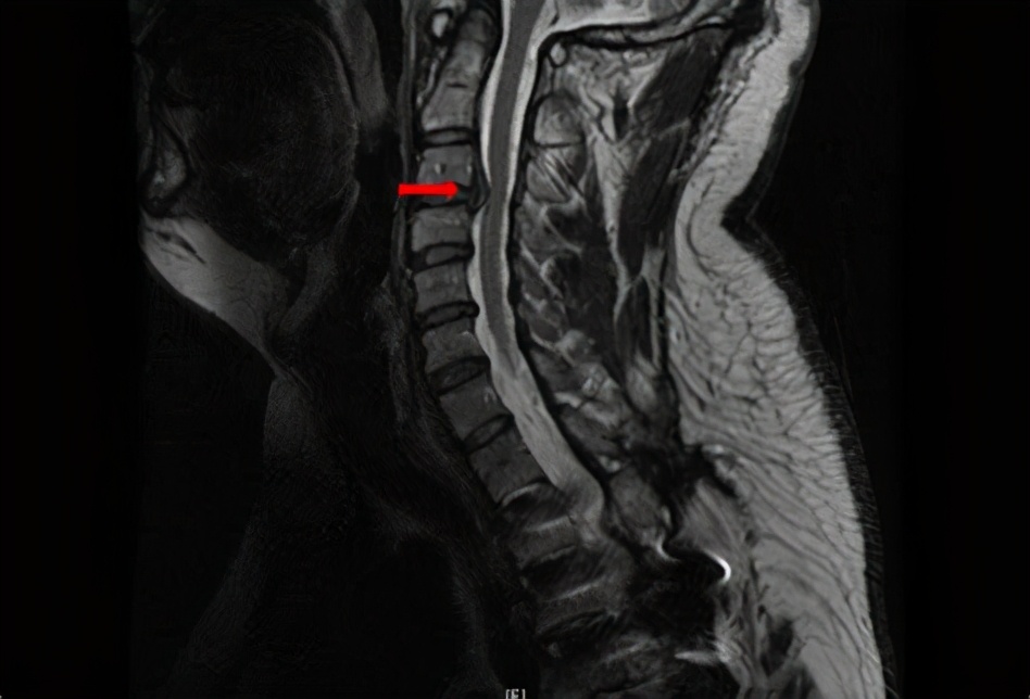 手麻是怎么造成的专家解说,手麻是什么病征兆怎么解决