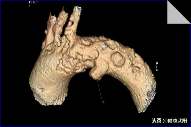 cta和血管造影怎么选择,血管oct检查与血管造影检查的区别