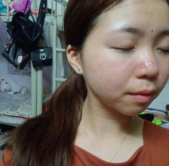 鼻子黑头毛孔粗大怎么去除,鼻子黑头严重毛孔粗大怎么办