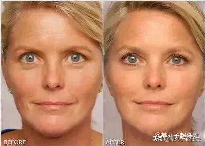 原来解决抬头纹这么简单,一个方法轻松解决抬头纹