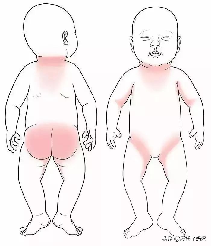 预防痱子小窍门,热痱和痱子的区别