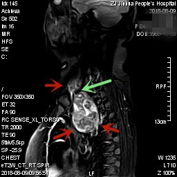 甲状腺肿瘤超大,胸骨后甲状腺肿病情是否很严重