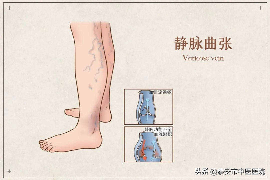 中医治疗下肢静脉曲张消除蚯蚓腿,微创闭合大腿根治静脉曲张过程