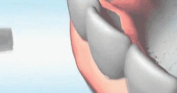 刷牙出血肿胀还刷牙吗,刷牙后牙龈红肿怎么回事