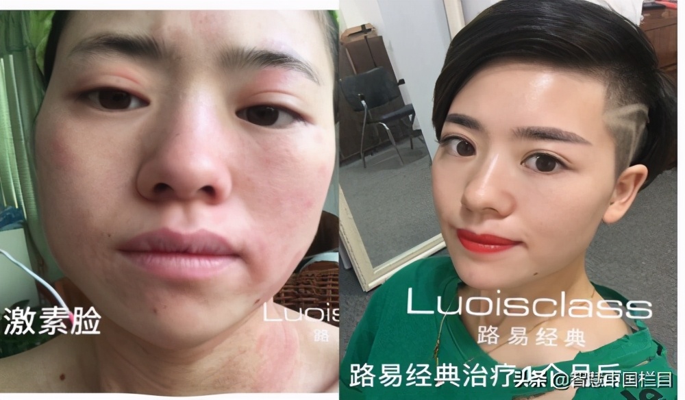 祛妊娠纹、祛斑哪家好、选择路易经典