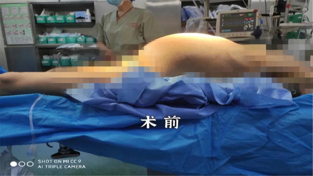 女子腹中取100斤重肿瘤,年轻女子查出大肌瘤