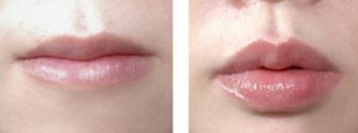 自体脂肪面部填充，让你的脂肪“动起来”