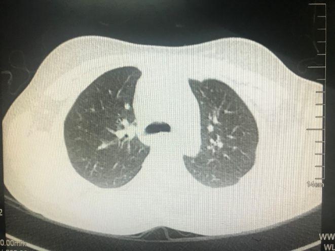 病例分析男性44岁反复咳嗽咳痰,长期咳嗽咳血是什么病的症状