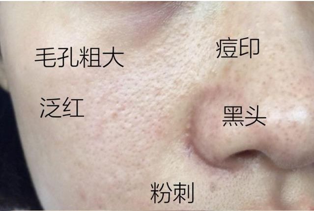 混油皮毛孔粗大怎么收缩毛孔,油皮毛孔大怎么护肤最好