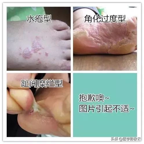 这是一条有味道的推送—jio气复发肿么办?