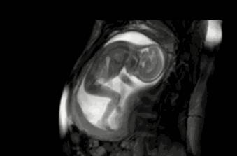 准妈妈的胎动变化,准妈妈胎动频繁是怎么回事