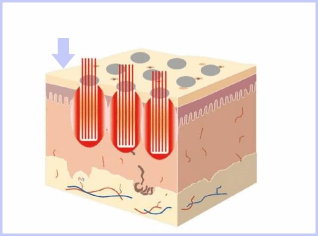 激光手术的创伤怎么消毒,做完脉冲激光破皮了怎么办