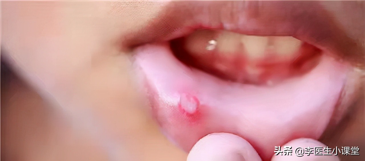 口腔溃疡用维生素c还是b敷溃疡处,口腔溃疡最快解决法吃维c