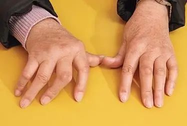 胳膊肘撞到麻筋之后一直麻,撞到胳膊肘突然麻了一下