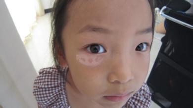 白癜风好转的迹象白斑的颜色,白癜风白斑变明显了