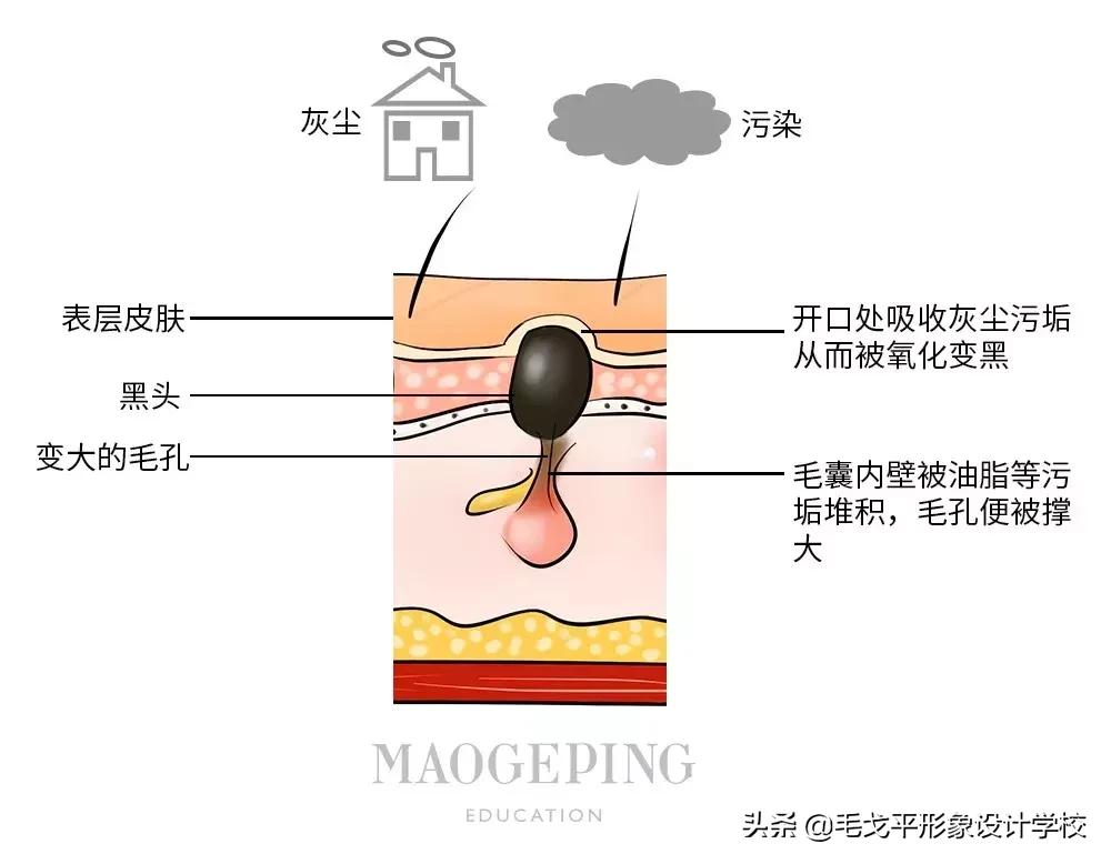 有黑头又泛红的草莓鼻怎么办,毛孔粗大草莓鼻清理黑头