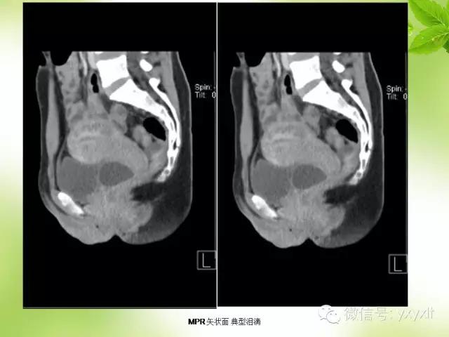 苗勒氏管囊肿在哪里,苗勒氏管囊肿是指什么