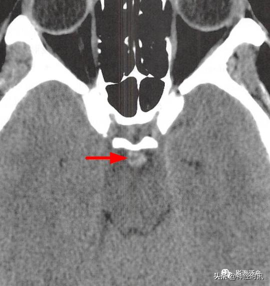 蛛血的临床表现,蛛血ct表现