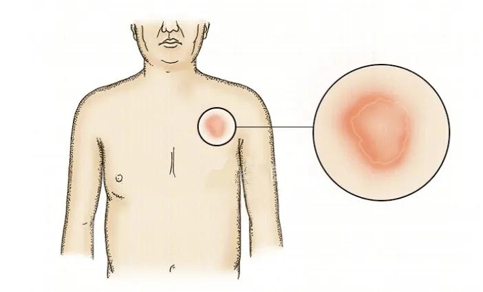 中医教你一招解决玫瑰糠疹,中医专家说健康