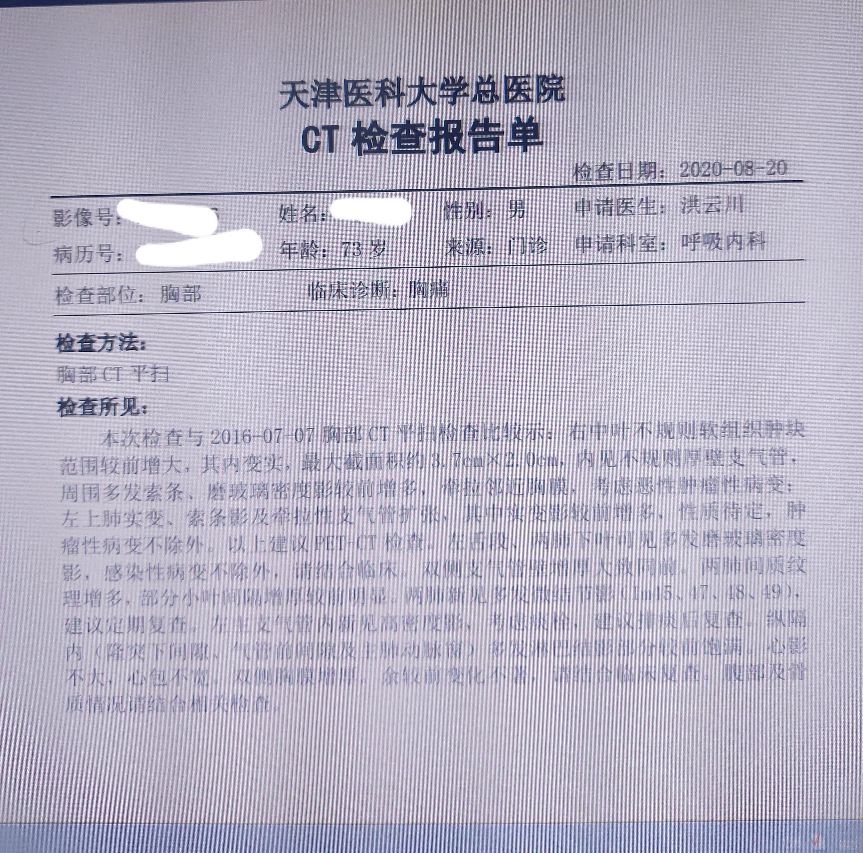 刘懿讲肺结节术前谈话,刘懿博士说小细胞肺癌