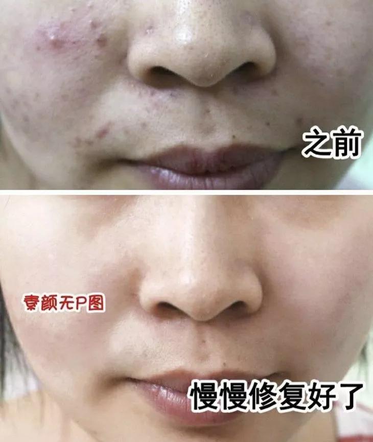 专治螨虫的洗面奶,螨虫专用洁面乳