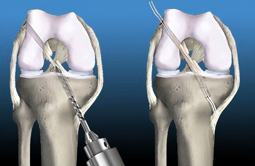 交叉韧带损伤患者科普,前交叉韧带损伤医生怎么问诊