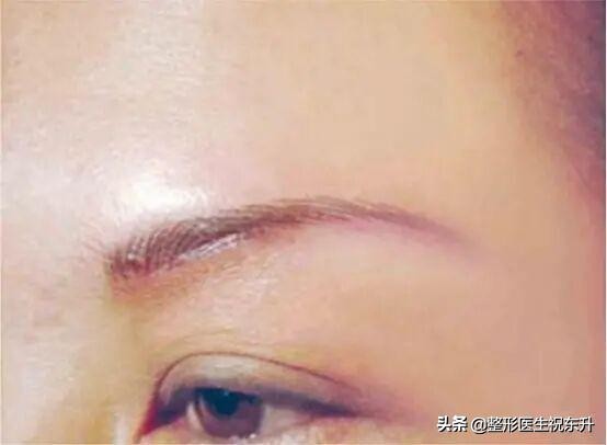 与大家聊一聊的技巧,做提眉手术后应该注意哪些事项