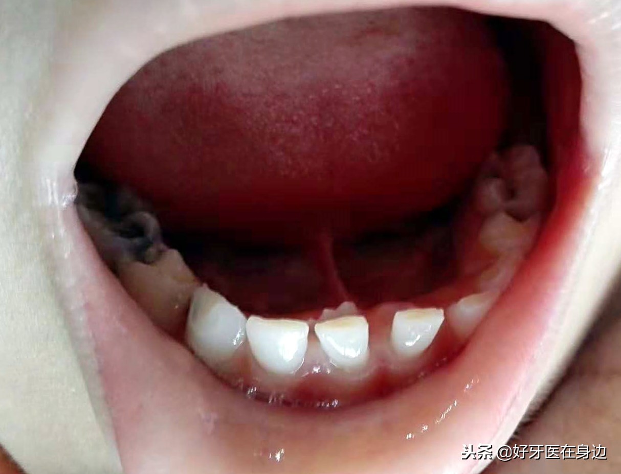 孩子出现双排牙要注意什么,1周岁双排牙怎么处理