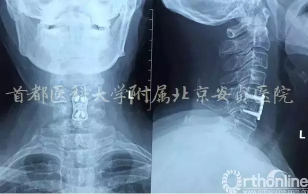 颈椎病引起的胸闷胸痛在哪个部位,颈椎病会引起咳嗽胸闷胸痛吗