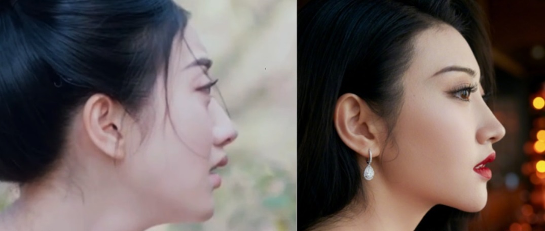 眼凸的人适合哪种双眼皮,眼凸但不近视是什么原因