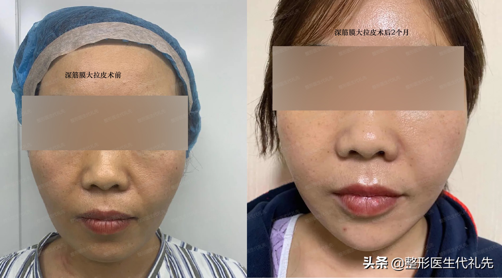 从整形医生的角度来聊一聊形成法令纹的原因以及改善方案