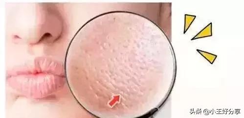 男皮肤粗糙毛孔粗大改善方法,怎么改善皮肤粗糙毛孔粗大