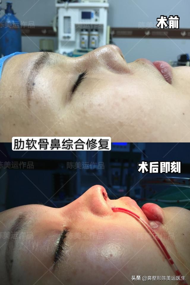 为什么医生都反对线雕隆鼻,到底要不要做线雕隆鼻