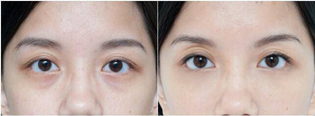 眼膜到底是不是智商税,保湿眼膜是不是智商税