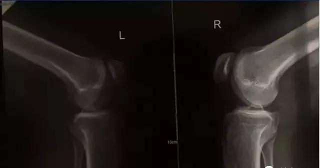 健身时关节有异响还能继续运动吗,训练时关节为什么会响