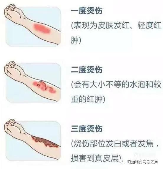 烧烫伤后有疤痕怎么办？《祝您健康》昭通市第二人民医院保刘俊医生支招