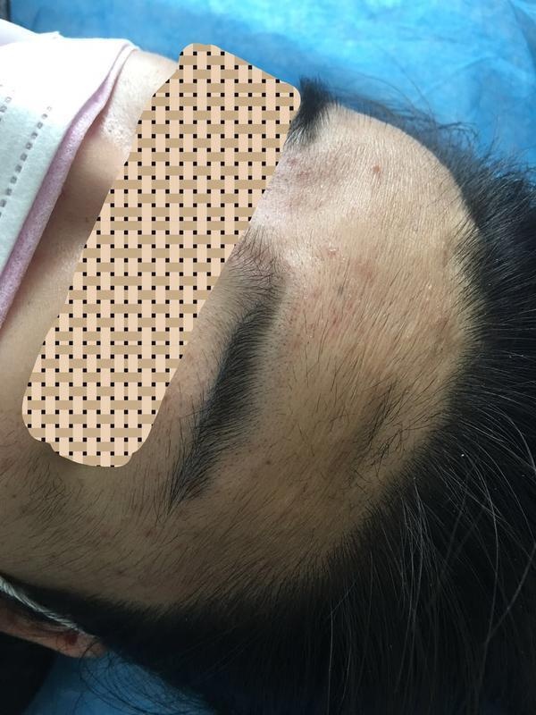 美肤店脱毛女孩,几岁去美容院脱毛