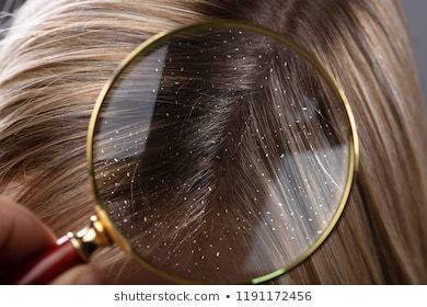 头油头屑多怎么去除小妙招,头油头屑怎么消除最快方法