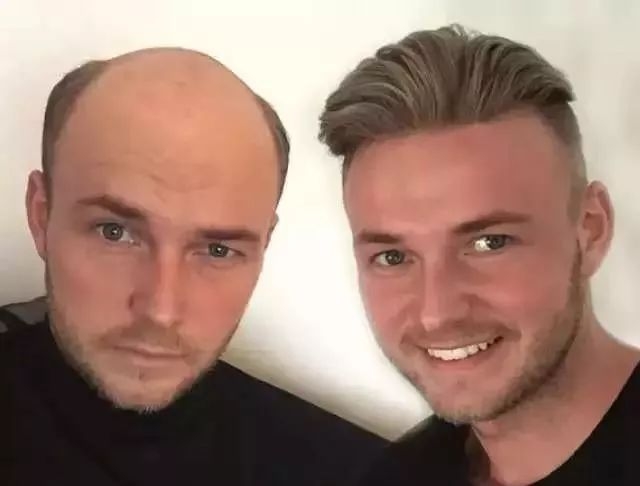 90后“未富先秃”！该拿什么拯救我的发际线？