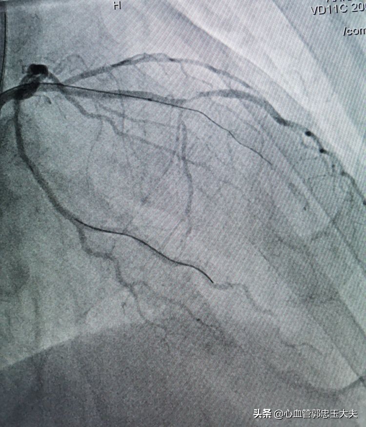 CTO遇到钙化病变怎样才能把血管打通?