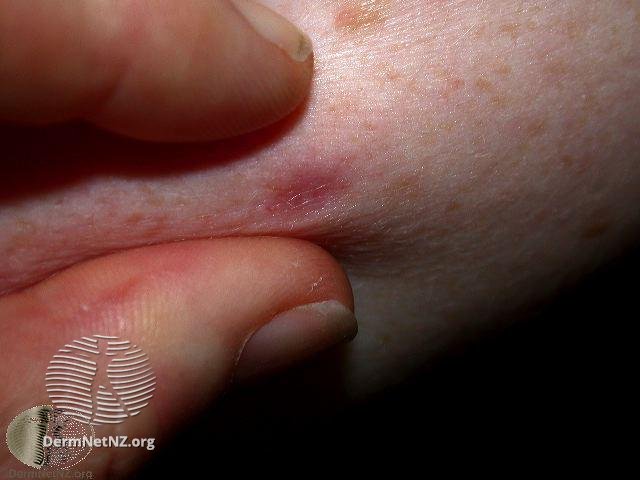 皮肤表面有个深褐色很硬的肿块？别担心，可能是皮肤纤维瘤