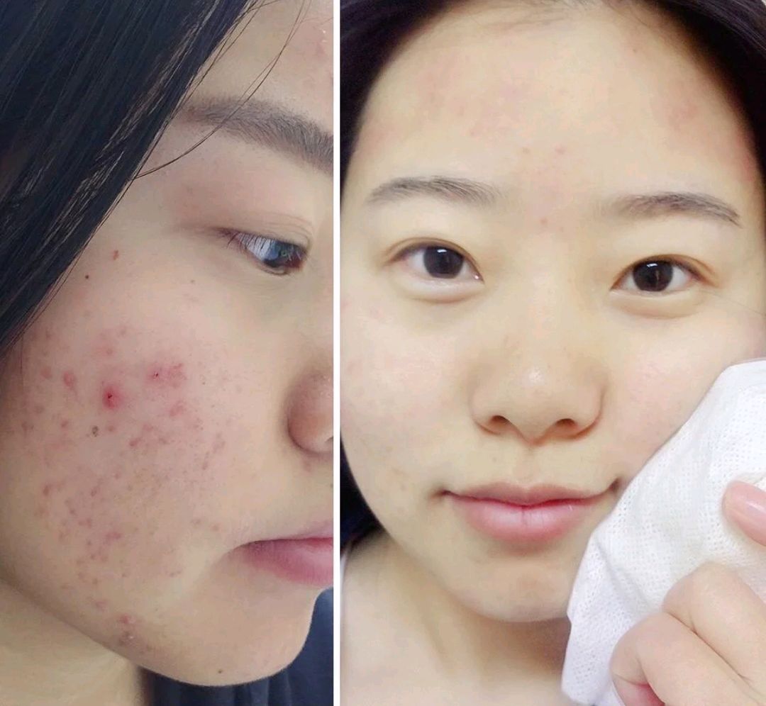 战痘舒缓精华,乐敦祛痘祛印霜测评