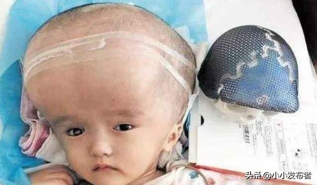 吃了三鹿奶粉的娃娃现在怎么样了,三鹿奶粉造成的大头娃娃现状视频